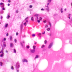 Neutrophils at a site of inflammation