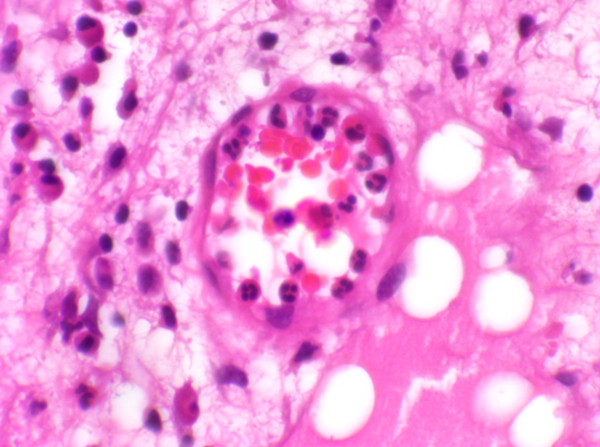 Neutrophils at a site of inflammation